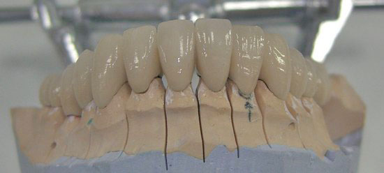 фото нижней челюсти, зубы, керамика, металлокерамика, работа симферопольского стоматолога 