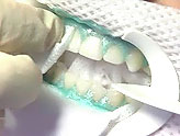 лазерное отбеливание зубов, верхней и нижней челюсти, индивидуальная каппа, Симферополь, Керчь, Крым